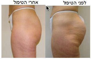 צלוליט לפני ואחרי
